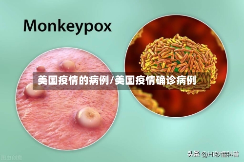 美国疫情的病例/美国疫情确诊病例-第1张图片